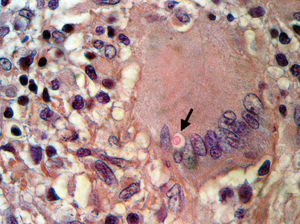 Histiocytic granuloma with lymphocytes and multinucleated giant cells and an encapsulated intracytoplasmic mucicarmine-positive structure identified as a Cryptococcus sp. (arrow) (hematoxylin and eosin– and Mayer mucicarmine–stained, magnification 400×).