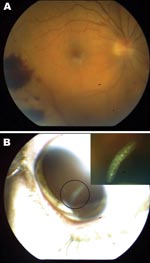 Thumbnail of Figure 1&nbsp;-&nbsp;A) Retinal hemorrhages visible on funduscopic examination of right eye of a 41-year-old woman, Nunavut, Canada, with ophthalmomyiasis intern). B) Segmented 3-mm larva with a cylindrical body, no visible spines, and indistinguishable anterior and posterior ends in the vitreous cavity, corresponding to the first instar of Hypoderma tarandi.