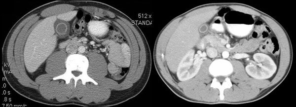Computed tomographic scans of abdomens of 2 patients with inflammation of the gallbladder.