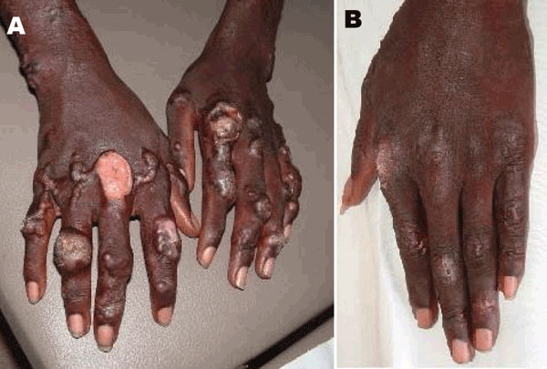 Infiltrated lesions on the patient's hands A) before and B) 70 days after treatment began.