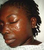 Thumbnail of Romaña sign. Photo of female patient from French Guiana who lives in a metropolitan area of France. She had returned to Maripassoula to visit her parents during the holidays between July 13, 2004, and September 3, 2004. When the patient sought treatment on September 3, 2004, she had fever and unilateral periorbital edema.