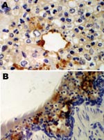 Thumbnail of Immunohistochemical staining for equine influenza A virus (brown stain) in sections of respiratory tissue from English foxhounds involved in 2002 respiratory disease outbreak, United Kingdom. A) Case 1, showing focal staining of an apparently necrotic bronchiole in an area of pneumonia; magnification x100. B) Case 2, showing a large amount of staining throughout the epithelium and inflammatory cells present in the brush border; magnification x200; hematoxylin counterstain.