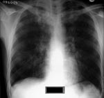 Thumbnail of Chest radiograph of a tuberculosis patient addicted to crack cocaine.