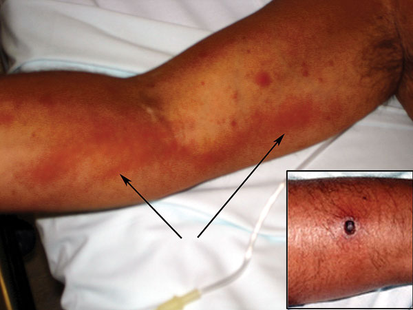 Lymphangitis extending from the right forearm to the axilla and (inset) eschar on right forearm, caused by Rickettsia sibirica mongolitimonae strain. Arrows indicate lymphangitis.