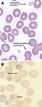Thumbnail of Giemsa-stained (A) and Wright-stained (B) peripheral blood smear from a newborn with probable Babesia microti infection. Parasitemia was estimated in this newborn at ≈15% based on the number of parasites per 200 leukocytes counted. The smear demonstrated thrombocytopenia and parasites of variable size and morphologic appearance and an absence of pigment. Magnification ×1,000.