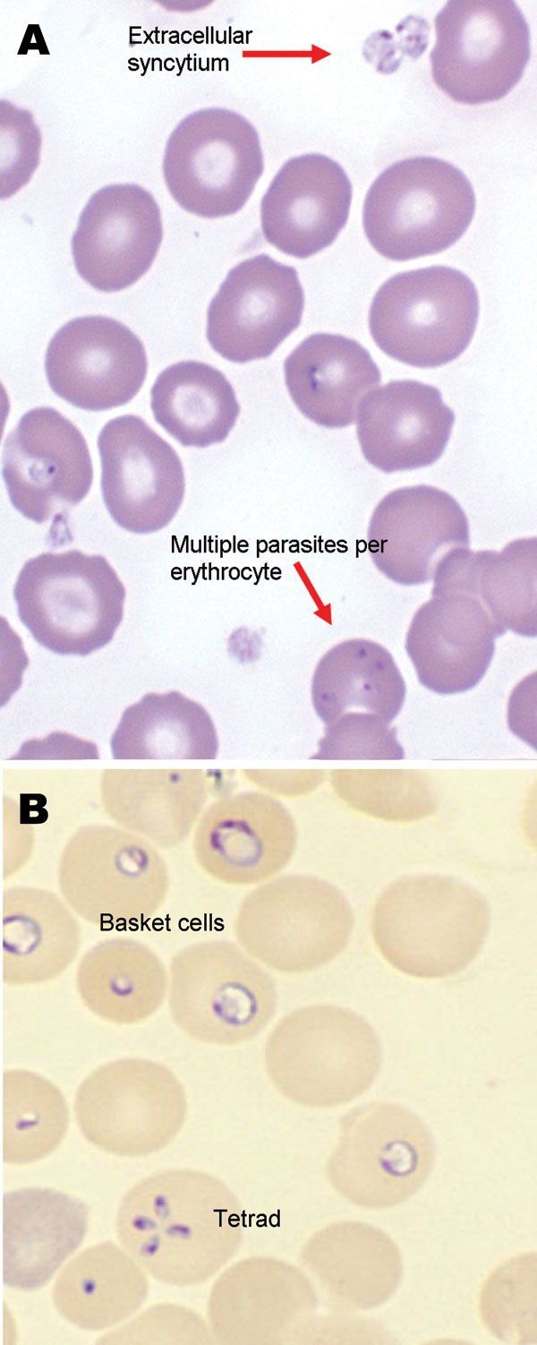 Giemsa-stained (A) and Wright-stained (B) peripheral blood smear from a newborn with probable Babesia microti infection. Parasitemia was estimated in this newborn at ≈15% based on the number of parasites per 200 leukocytes counted. The smear demonstrated thrombocytopenia and parasites of variable size and morphologic appearance and an absence of pigment. Magnification ×1,000.