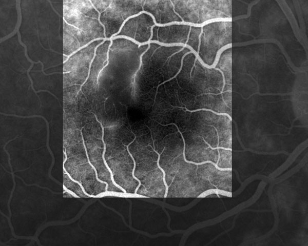 Fluorescein angiograph of the right eye of the patient showing retinal occlusive vasculitis with arteriolar leakage at late phase.