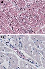 Thumbnail of Histologic and immunohistochemical evaluation of heart tissue. A) Lymphohistiocytic inflammatory cell infiltrates in the myocardium (hematoxylin and eosin stain; original magnification ×25). B) Immunohistochemical detection of spotted fever group rickettsiae (red) in perivascular infiltrates of heart (immunoalkaline phosphatase with naphthol-fast red substrate and hematoxylin counterstain; original magnification ×250.
