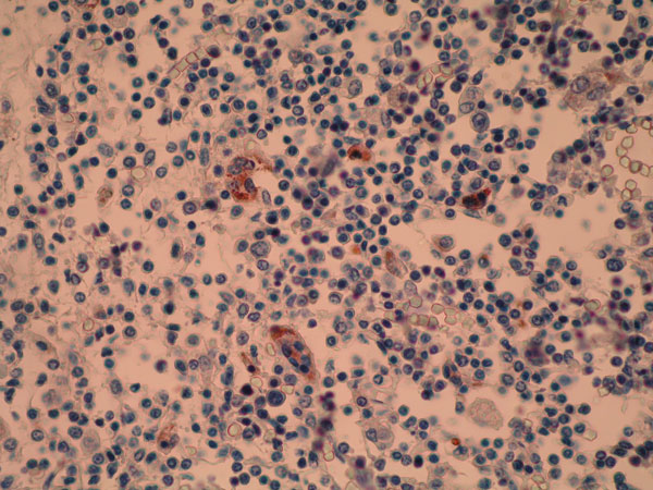 Lymph node of pilot whale. Positive intracytoplasmic immunoperoxidase staining of morbilliviral antigen in several syncytial cells and in monocyte-like cells. Avidin-biotin-peroxidase with Harris hematoxylin counterstain. Original magnification ×400.
