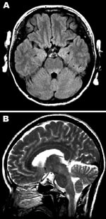 Thumbnail of Magnetic resonance images of the brain. A) Hyperintense lesions in the tegmentum of the pons in the axial section of the fluid-attenuated inversion recovery image. B) In the sagittal section of the T2-weighted image, hyperintense lesions are present in the tegmentum of the midbrain, pons, and medulla oblongata.