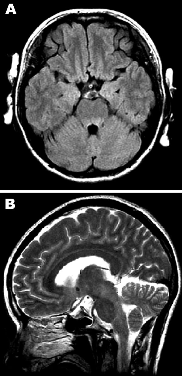 Magnetic resonance images of the brain. A) Hyperintense lesions in the tegmentum of the pons in the axial section of the fluid-attenuated inversion recovery image. B) In the sagittal section of the T2-weighted image, hyperintense lesions are present in the tegmentum of the midbrain, pons, and medulla oblongata.