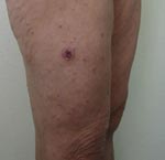 Thumbnail of Typical eschar and spots on the leg of a patient with Mediterranean spotted fever.