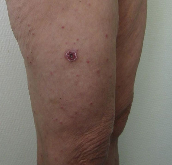 Typical eschar and spots on the leg of a patient with Mediterranean spotted fever.