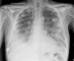 Thumbnail of Chest radiograph of patient 11 at time of admission to hospital, before intubation, demonstrating extensive bilateral airspace disease.