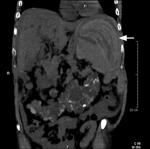 Thumbnail of Coronal view of unenhanced abdominal computed tomography demonstrating splenic enlargement with endocapsular hematoma and intraperitoneal hemorrhage (arrows).