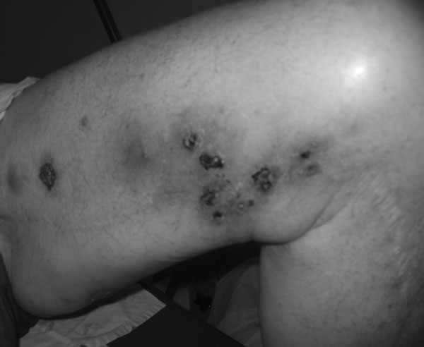 Nodular-ulcerative skin lesions on the left thigh caused by Mycobacterium haemophilum infection in a patient with chronic lymphocytic leukemia (patient 1) whose condition had been treated with alemtuzumab.