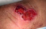 Thumbnail of Ulcer (3 × 6 cm) on anterior side of the left leg of the patient, showing an erythematous border.