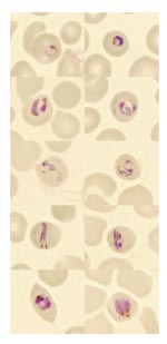 Thumbnail of Microscopic findings in the thin blood smears of a patient with Plasmodium knowlesi malaria. Early ring forms are shown in the first row, later trophozoites in the second and third rows, trophozoites resembling band forms in the fourth row, and putative early gametocytes or schizonts in the fifth row. Size of the infected erythrocytes is normal. Antimalarial medications, given 8 hours before the blood shown in the smear was drawn, could have affected morphology. (Original magnification ×1,000.)