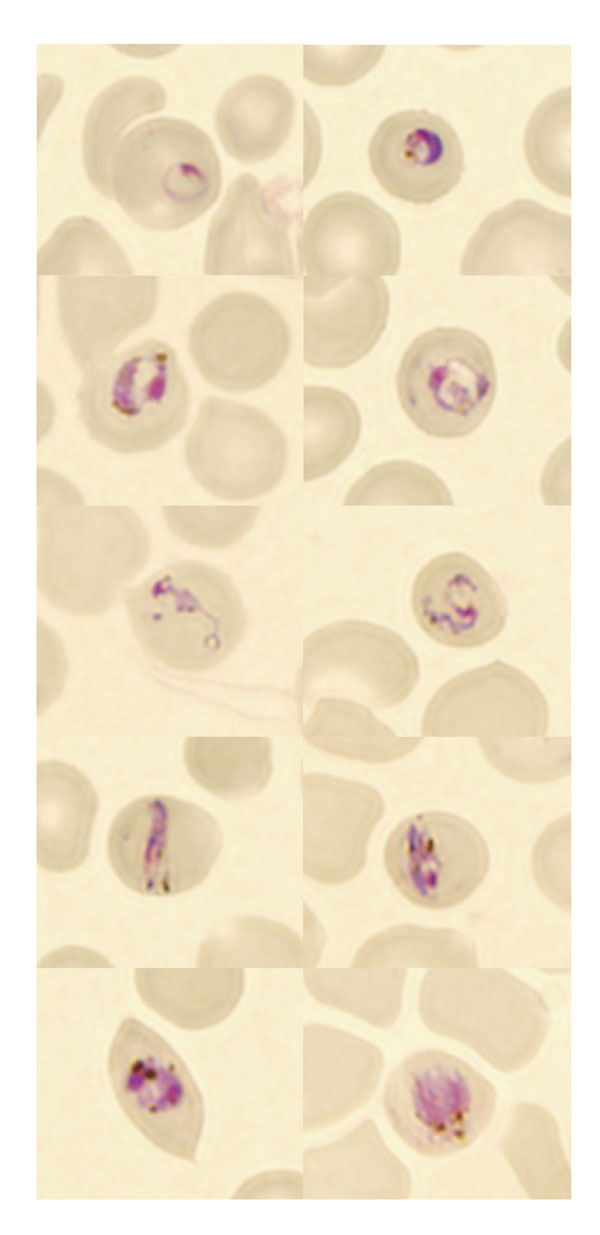 Microscopic findings in the thin blood smears of a patient with Plasmodium knowlesi malaria. Early ring forms are shown in the first row, later trophozoites in the second and third rows, trophozoites resembling band forms in the fourth row, and putative early gametocytes or schizonts in the fifth row. Size of the infected erythrocytes is normal. Antimalarial medications, given 8 hours before the blood shown in the smear was drawn, could have affected morphology. (Original magnification ×1,000.)