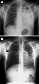 Thumbnail of Poster-anterior chest radiographs of patient with multidrug-resistant tuberculosis. A) Radiograph taken at diagnosis, demonstrating dense consolidation of the left lower lobe and lingula. A left apical cavity is present. Minimal change is also noted in the right mid-lung zone. B) Radiograph taken after 5 months of directly observed therapy. Marked clearance is noted on the left; however, a new small cavitary lesion with surrounding infiltrate is noted in the right mid-lung zone (bla