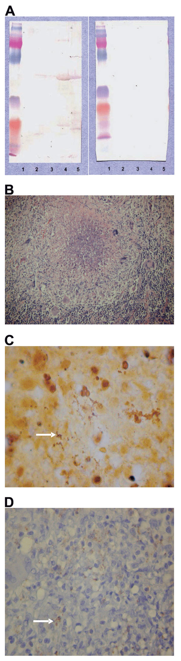 A) Western blotting analysis of lymph node specimen from the patient before 1) and after 2) cross-adsorption with Bartonella alsatica. Lane 1, B. quintana; lane 2, B. henselae; lane 3, B. elizabethae; lane 4, B. vinsonii subsp. berkhoffii; lane 5, B. alsatica. B) Characteristic histologic change in the lymph node with B. alsatica infection. Shown is an inflammatory granulomatous process with central microabscess surrounded by a ring of macrophages and rare giant cells (hematoxylin and eosin stain, original magnification x100). C) Bacteria (arrow) in an abscess formation mixed with necrotic debris (Warthin-Starry silver stain, original magnification x1,000). D) Immunohistochemical detection of B. alsatica (arrow) in lymph node pulp with an extracellular distribution (polyclonal antibody and hematoxylin counterstain, original magnification x400).