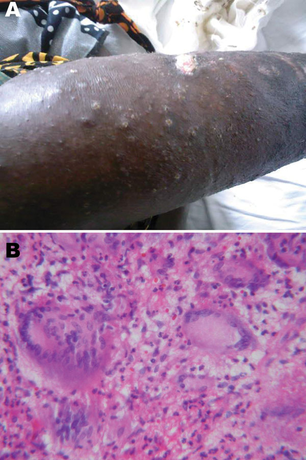 A 36-year-old HIV-infected woman with Mycobacterium avium disease. A) Photograph of skin lesions on right leg, taken before treatment. B) Histopathologic appearance of skin biopsy specimen from right leg lesion (stain, hematoxylin and eosin; magnification ×40).