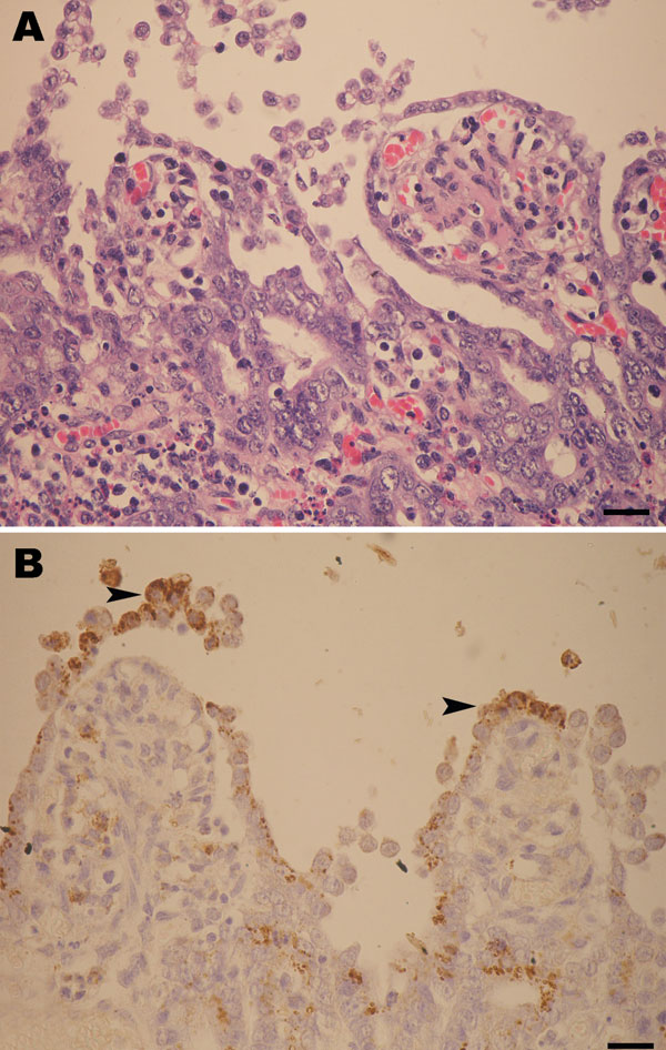 A) Marked shortening and blunting of the intestinal villi (scale bar = 25 µm). B) Intestinal epithelial cells expressing porcine epidemic diarrhea virus antigen (arrowheads) in the cytoplasm (colon), visible as brown staining (scale bar = 25 µm).