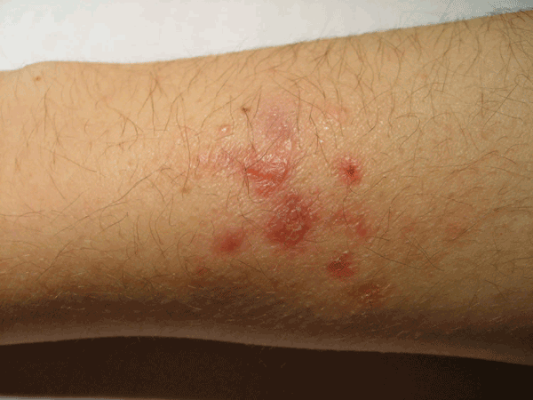Mycobacterium marinum infection of the arm of a fish-tank worker.