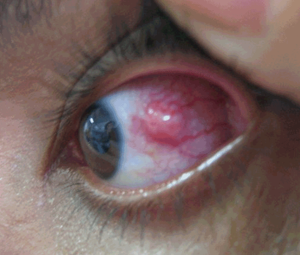 Conjunctival infection and opaque scleral nodule with vascularization in case-patient with confirmed ocular disease, Araguatins, Brazil. Source: Dr Leandro Alencar/Dr Carlos Franklin.