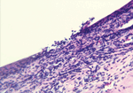 Thumbnail of Scleral nodule biopsy sample, showing microulceration of corneal epithelium (magnification ×20, hematoxylin and eosin stain), Araguatins, Brazil. Source: Department of Pathology, University of Brasília.