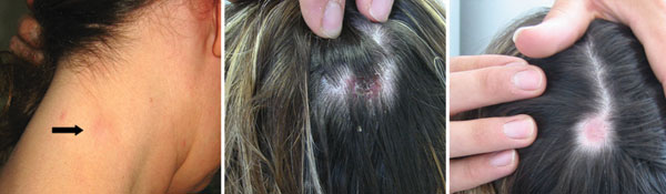 Typical signs of TIBOLA (tick-borne lymphadenopathy)/DEBONEL (Dermacentor-borne necrosis erythema and lymphadenophy). Here, infections were caused by Rickettsia slovaca , resulting in cervical lymphadenopathy (left panel, arrow), inoculation on the scalp (middle panel), and residual alopecia 4 weeks later (right panel).