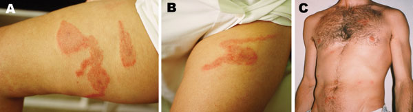 Photographs of 3 persons with skin lesions of Pyemotes dermatitis during the same outbreak in Castellón, Spain, showing the comet sign in 2 affected women (panels A, B), and macular form of the lesions in 1 of the affected investigators (panel C).