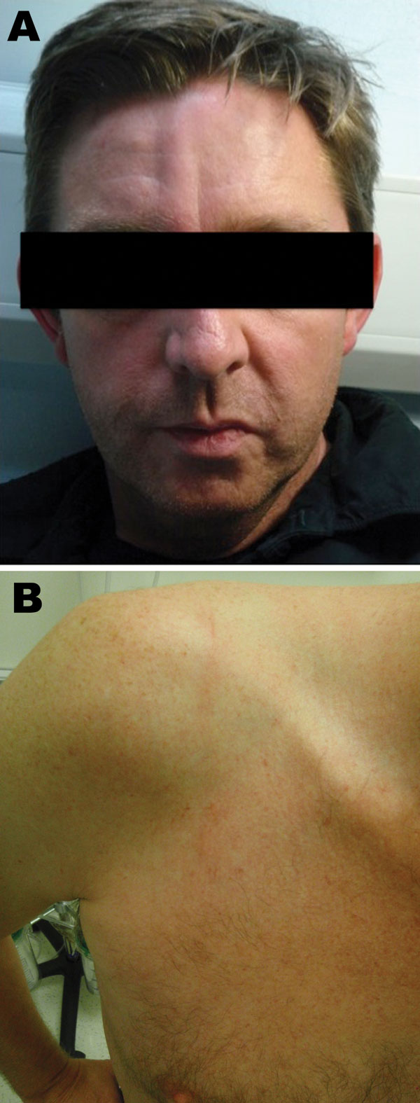 Cutaneous larva migrans on the forehead (A) and shoulder (B) of a male British tourist who had visited Botswana.