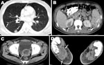 Thumbnail of Computed tomography images showing multiple abscesses in the right lung (A), spleen and upper pole of the right kidney (B), prostate gland (C), and plantar aspect of the right foot (D) (arrows) of the patient.