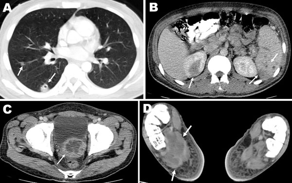 Computed tomography images showing multiple abscesses in the right lung (A), spleen and upper pole of the right kidney (B), prostate gland (C), and plantar aspect of the right foot (D) (arrows) of the patient.