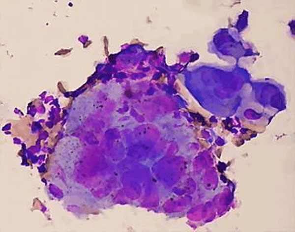 Photomicrograph of patient's multinculeated giant keratinocytes.
