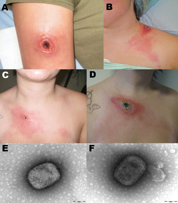 Cowpox virus infection in 3 persons in northern France caused by transmission from infected pet rats. Cutaneous lesions caused by cowpox virus are shown in patient 1 (A), patient 3 (B) and patient 4 (C, D). The 2 latter patients had lymphangitis associated with the local lesion. Panel C was obtained on January 30, 2009, panel D on February 6, 2009. Negative-staining electron microscopy showed mulberry forms with conspicuous but short, randomly arranged surface tubules (E) and capsule forms with