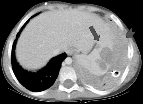 Computed tomographic scan showing infection with Aspergillus viridinutans, originating in the lungs, extending into the diaphragm (arrowhead), and producing hypodense splenic lesions (arrow).