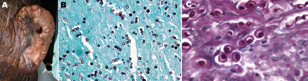 A) Multiple, confluent, keloid-like, hyperchromic nodules with flat shiny surfaces involving the entire free border, posterior aspect, and lobule of the left ear of a fisherman, Venezuela. B) Numerous Lacazia loboi tissue-phase organisms within the stroma. Note the typical chain pattern showing simple gemation budding (Gomori-Grocott stain, magnification ×100). C) Yeast cells showing typical double refraction of the membrane and protoplasmic bodies within cells (periodic acid–Schiff stain, magnification ×600).