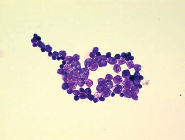 Gram-positive spherical unicellular organisms in a blood culture from a 79-year-old man with chronic lymphocytic leukemia. Magnification ×1,000.