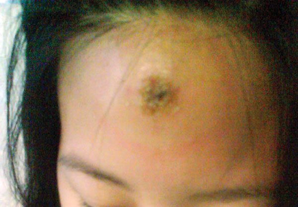 Chancre at site of tsetse fly bite on forehead of pregnant patient with trypanosomiasis.