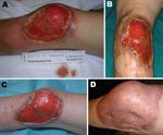 Thumbnail of Progression of Buruli ulcer adjacent to the left knee of United Kingdom tourist after returning from Latin America. A) November 2007, on patient’s return to the United Kingdom; B) January 2008, before Mycobacterium ulcerans therapy; C) April 2008, after 12 weeks of antimicrobial drug therapy; D) January 2009, 9 months after split-skin grafting.