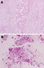 Thumbnail of Histologic analysis showing necrosis of subcutaneous fat and deep dermal tissue of the patient. A) Noninflammatory infarction-like necrosis related to cytopathic effect of the mycolactone toxin secreted by Mycobacterium ulcerans. B) Abundant mycobacteria within the necrosis.