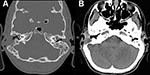 Thumbnail of Computed tomography images of a patient with Mycobacterium abscessus otomastoiditis. Extensive bone destruction in the right mastoid and associated right-sided mucosal swelling can be seen. A) Bone tissue window setting; B) soft tissue window setting.