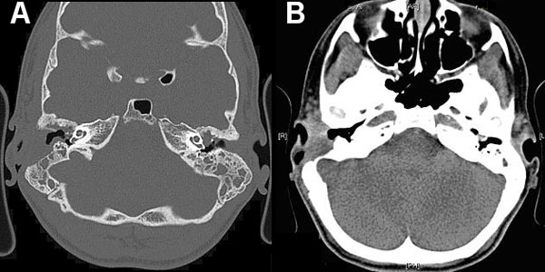 Computed tomography images of a patient with Mycobacterium abscessus otomastoiditis. Extensive bone destruction in the right mastoid and associated right-sided mucosal swelling can be seen. A) Bone tissue window setting; B) soft tissue window setting.