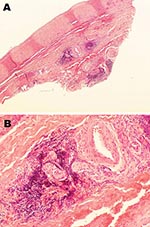 Thumbnail of Histopathologic appearance of abdominal aortic biopsy sample from 35-year-old mink farmer in Denmark who had been exposed to Aleutian mink disease parvovirus−infected mink for 10 years (patient 1). A) Perivascular, adventitial lymphoplasmacytoid infiltration. Original magnification ×4. B) Minimal atherosclerotic changes. Original magnification ×20.
