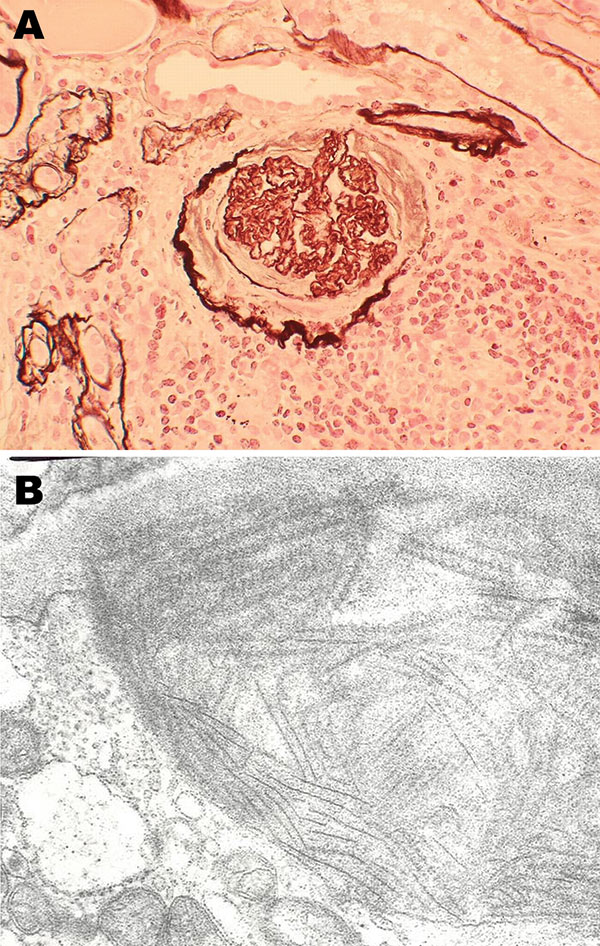 Histopathologic appearance of renal biopsy sample from 54-year-old mink farmer in Denmark who had been exposed to Aleutian mink disease parvovirus−infected mink for 34 years (patient 2). A) Glomeruli with hypercellularity and crescents. Original magnification ×20. B) Electron microscopy showing distinct extracellular deposits of coarse 20-nm fibrils (microtubular structures) characterized as immunotactoid glomerulopathy. Original magnification ×100,000.