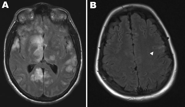 Magnetic resonance imaging scans of the brains of 2 patients with Hendra virus encephalitis, Australia, 2008. A) Patient 1 on day 18 of illness, showing cortical and subcortical hyperintense foci. <!-- INSERT SHAPE -->B) Patient 2 on day 25 of illness, showing hyperintense foci in the left precentral gyrus (arrowhead).