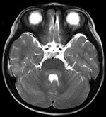 Thumbnail of Axial T2-weighted slice of brain by magnetic resonance imaging, showing hyperintensity lesions in the pons and cerebellum around the fourth ventricle.