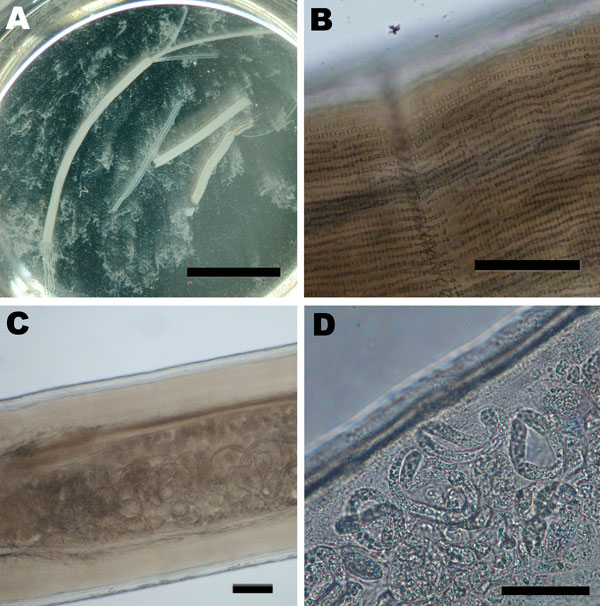 Images of the adult female Dirofilaria repens worm removed from a subcutanous nodule of the patient. A) Macroscopic view of sections of the worm in saline in a petri dish. Two uteri and the intestinal tract can be seen protruding from a disrupted end of the largest section. The saline is turbid due to the massive release of microfilariae, which are not discernible at this magnification. Scale bar = 1 cm. B) Microscopic view of the outer cuticula with multiple longitudinal ridges. Scale bar = 100